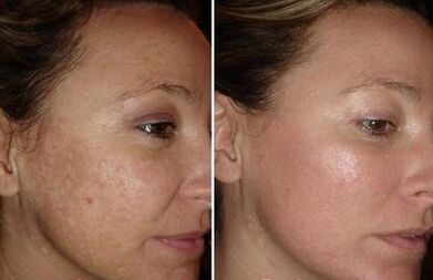 Rejuvenation of laser face skin before and after photos