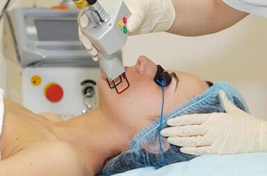 Types of Laser Facial Resuscitation
